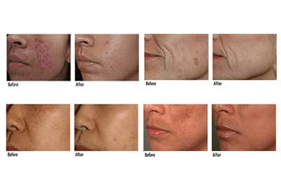 Latest technology SPECTRA VRM III